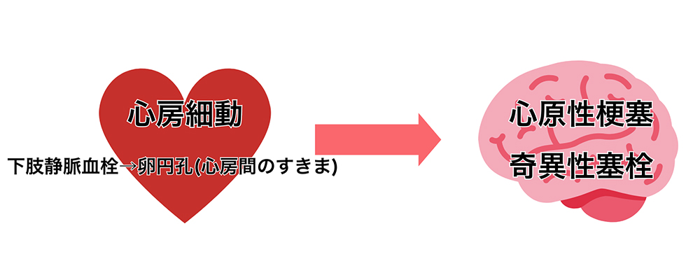 心臓・血管の病気が脳に影響を及ぼす例